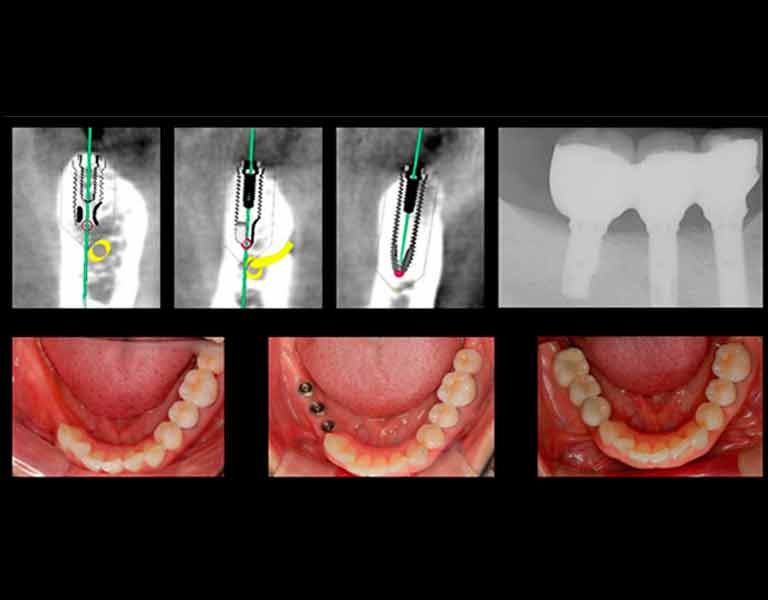 デジタルインプラント