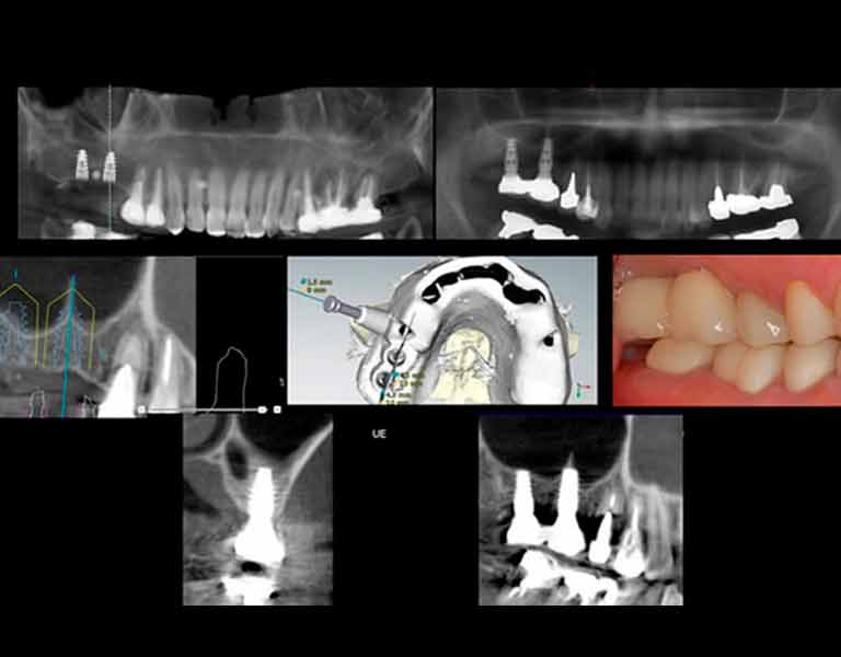 デジタルインプラント