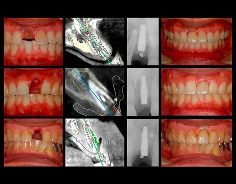 デジタルインプラント
