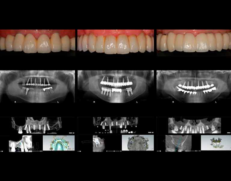 デジタルインプラント
